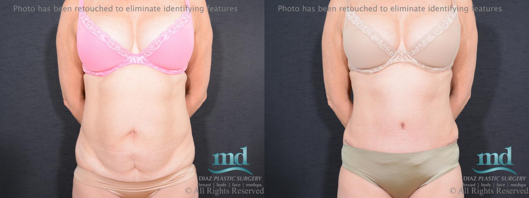 Before & After Tummy Tuck Case 83 View #1 View in Melbourne, FL