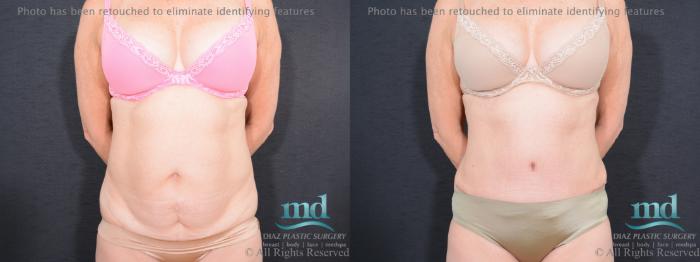 Before & After Tummy Tuck Case 83 View #1 View in Melbourne, FL