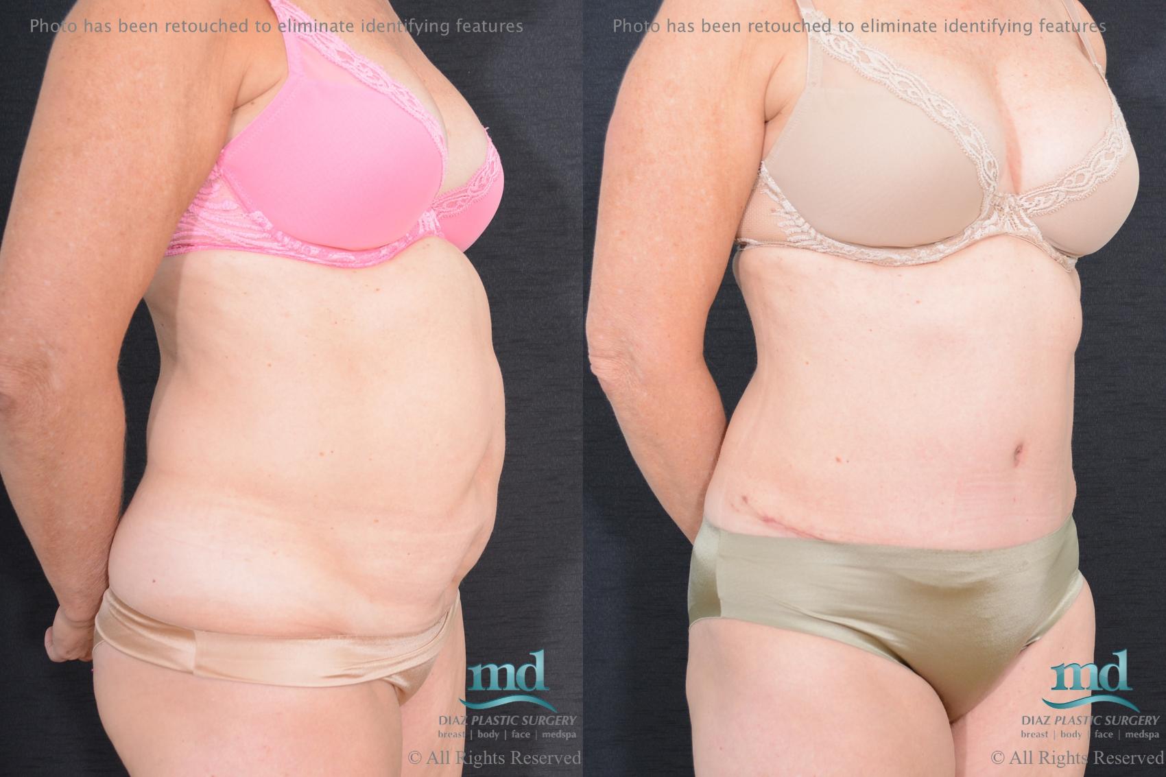 Before & After Tummy Tuck Case 83 View #2 View in Melbourne, FL