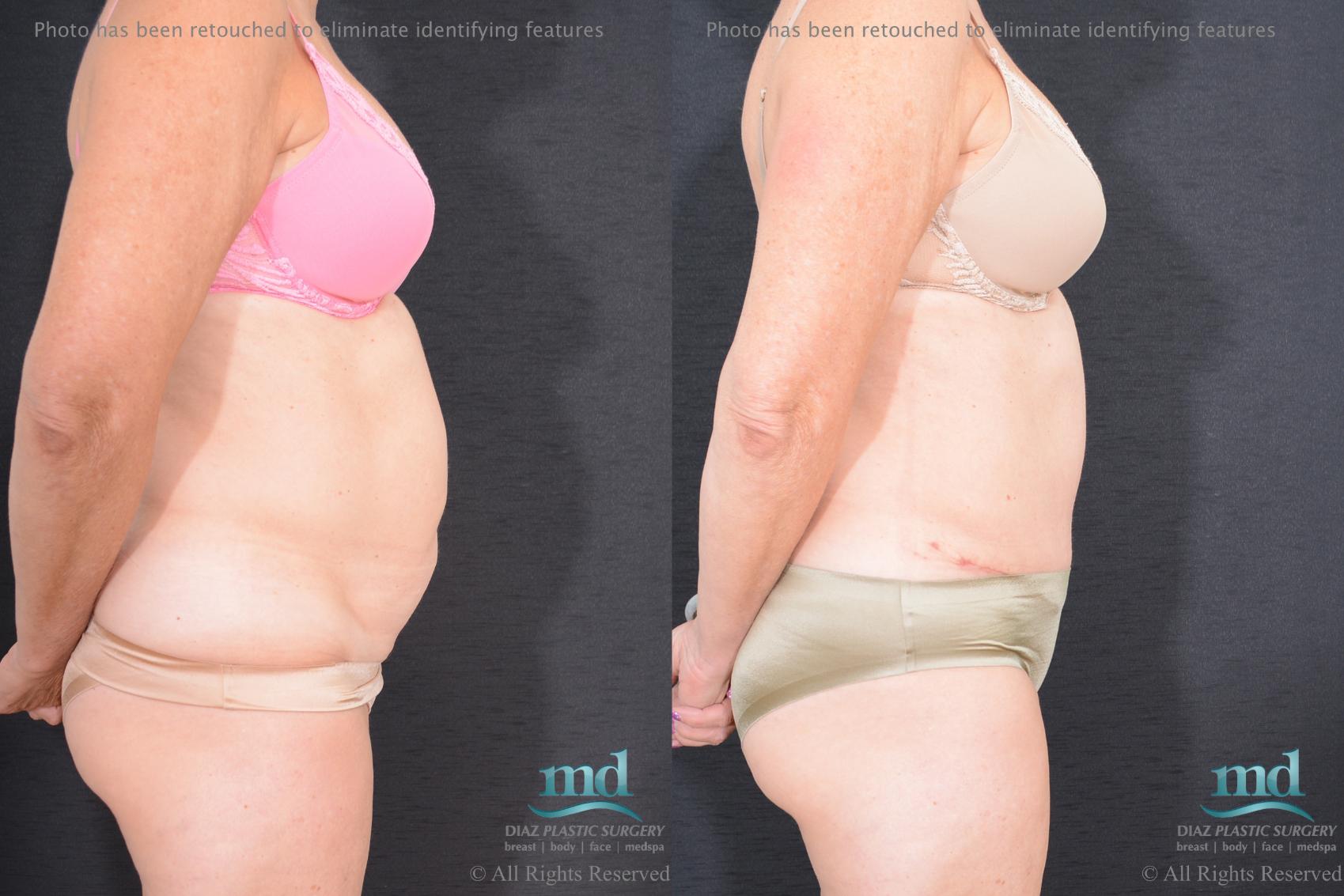 Before & After Tummy Tuck Case 83 View #3 View in Melbourne, FL
