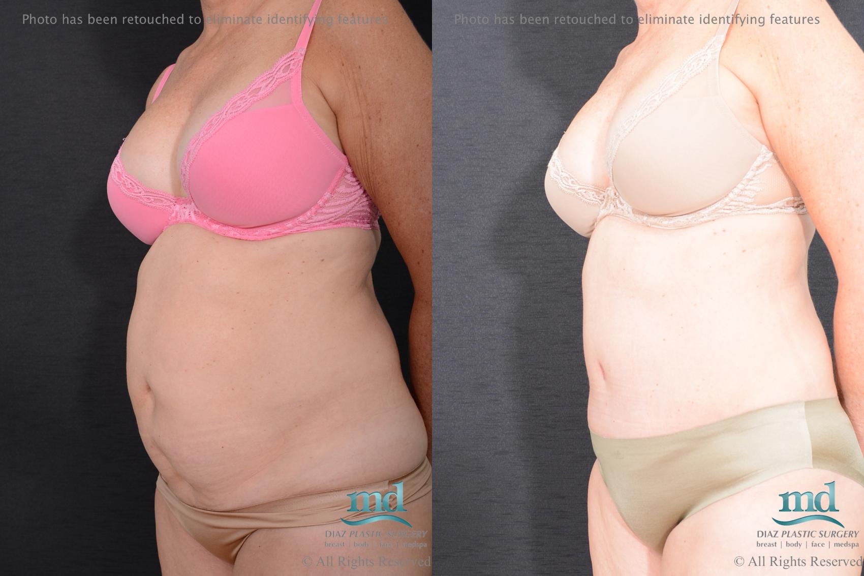 Before & After Tummy Tuck Case 83 View #4 View in Melbourne, FL