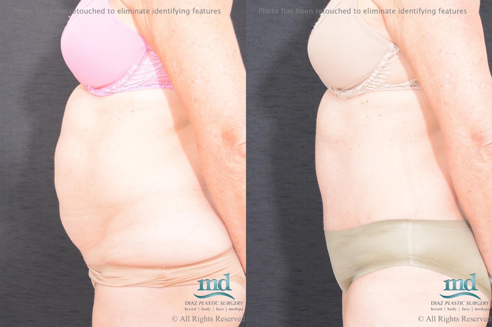 Before & After Tummy Tuck Case 83 View #5 View in Melbourne, FL