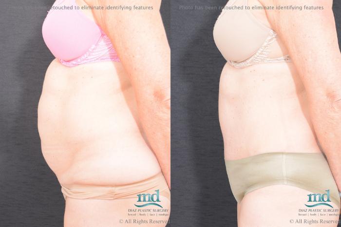 Before & After Tummy Tuck Case 83 View #5 View in Melbourne, FL