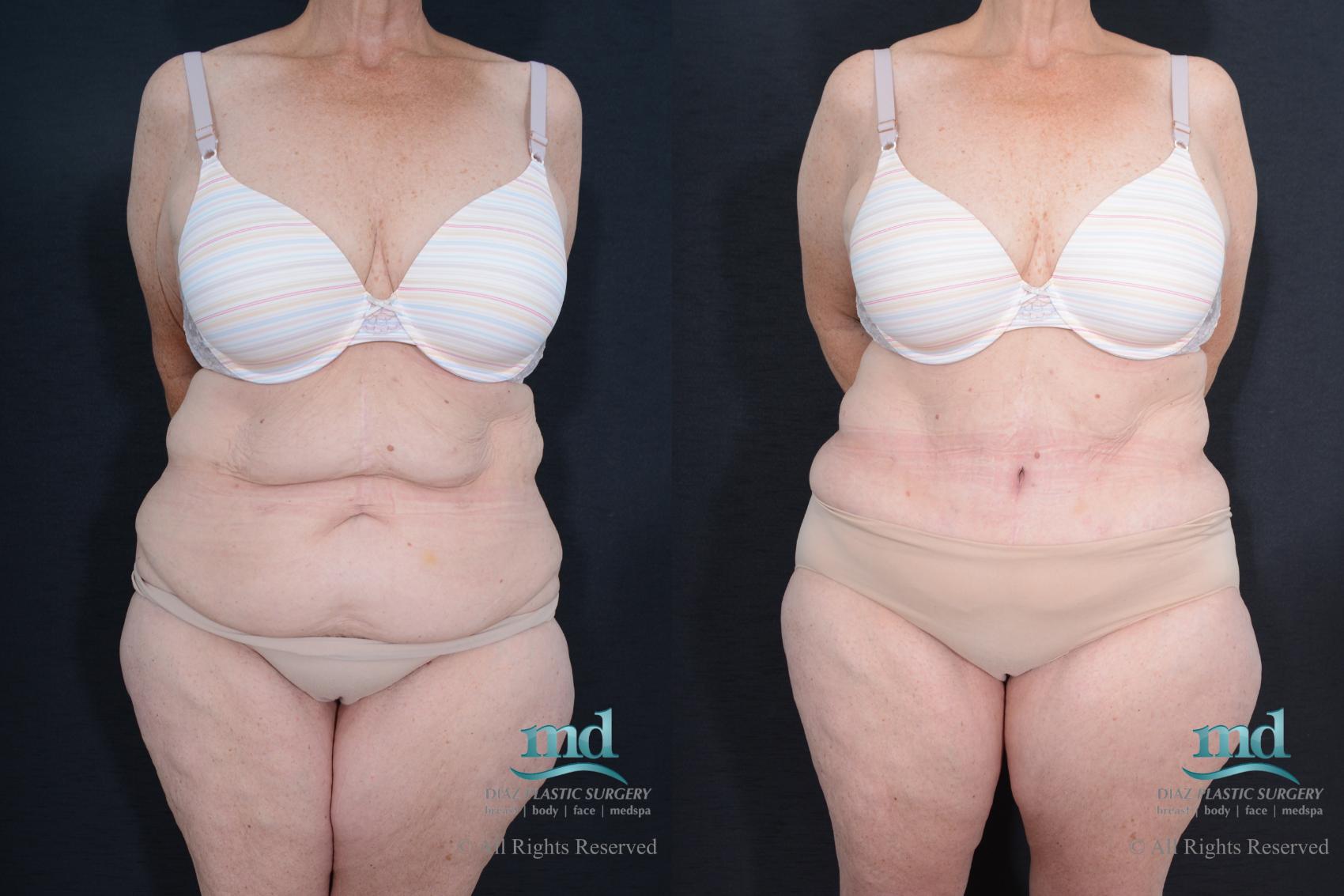 Before & After Tummy Tuck Case 84 View #1 View in Melbourne, FL
