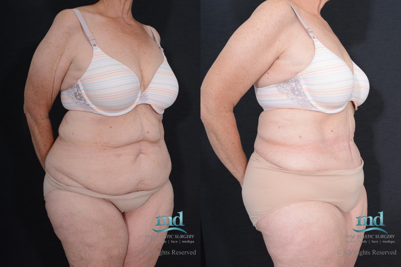 Before & After Tummy Tuck Case 84 View #2 View in Melbourne, FL