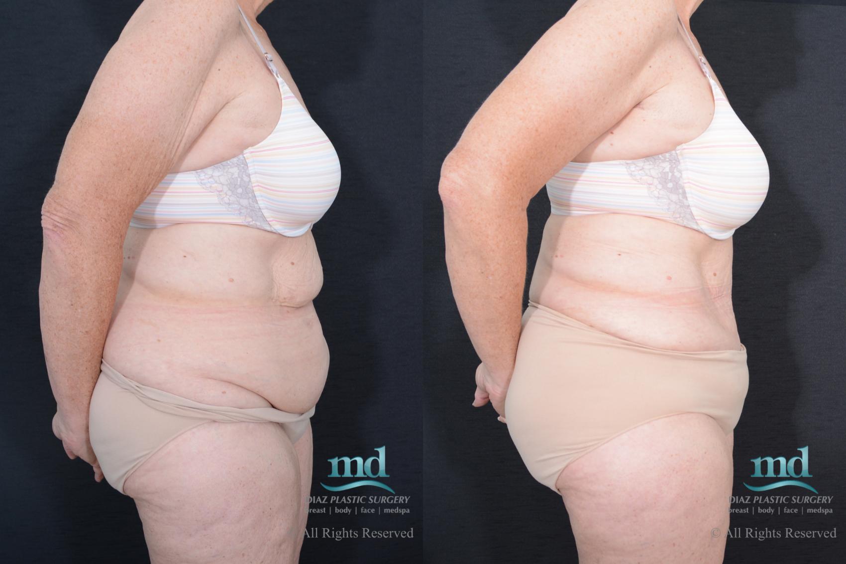 Before & After Tummy Tuck Case 84 View #3 View in Melbourne, FL