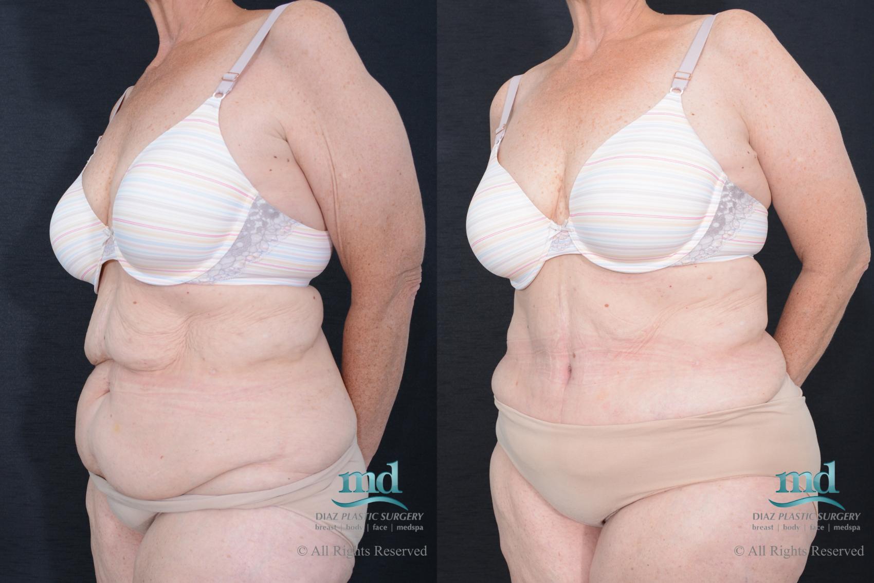 Before & After Tummy Tuck Case 84 View #4 View in Melbourne, FL