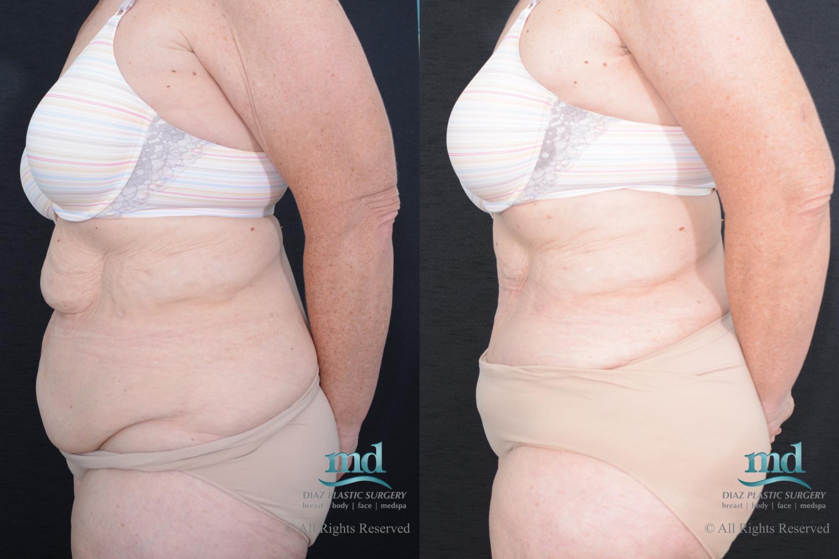 Before & After Tummy Tuck Case 84 View #5 View in Melbourne, FL