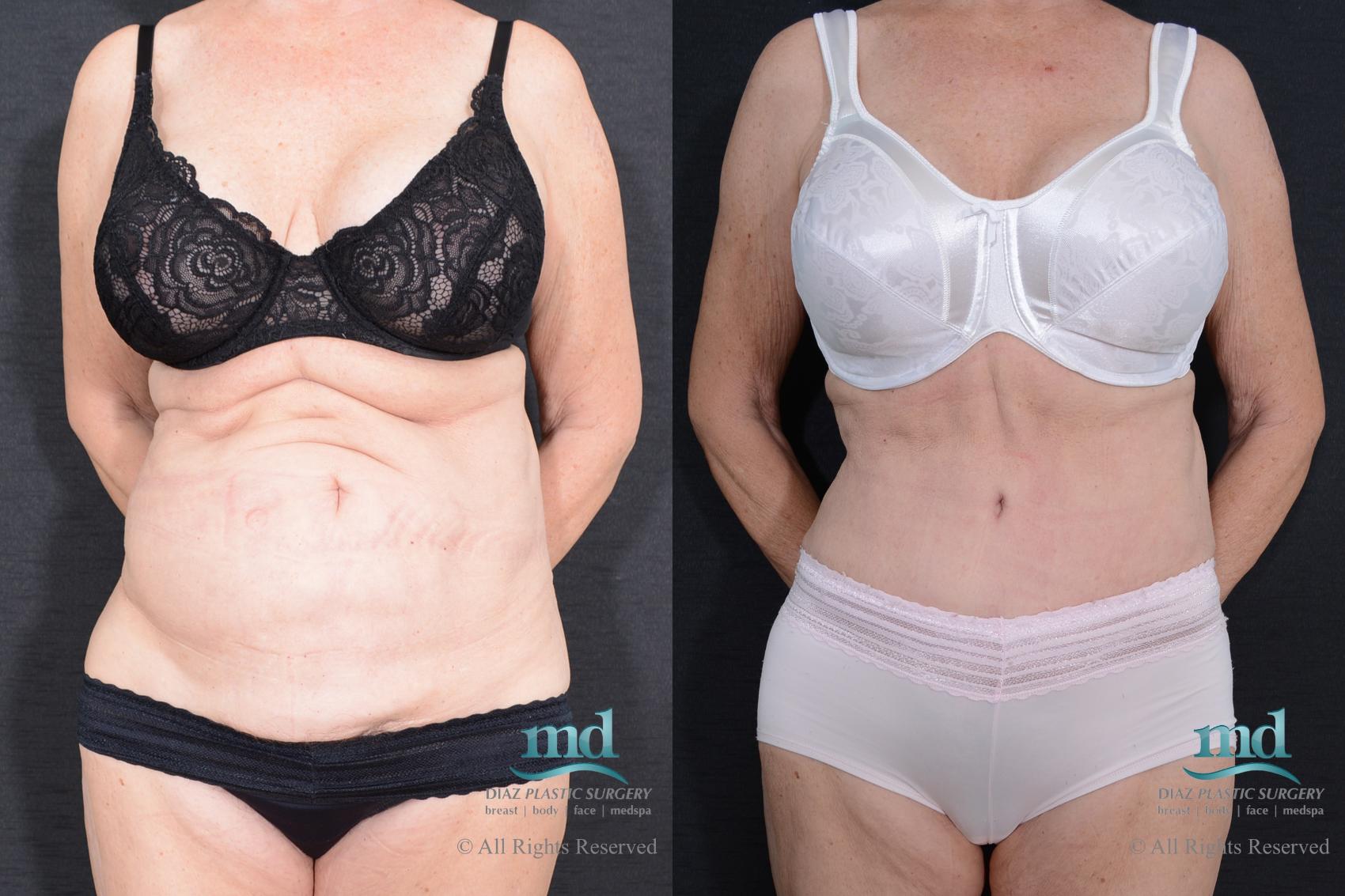 Tummy Tuck Before and After Photos Case 87, Melbourne, FL