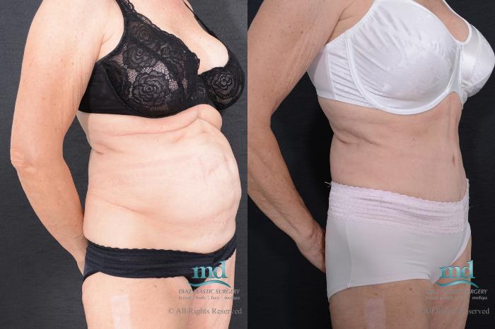 Before & After Tummy Tuck Case 87 View #2 View in Melbourne, FL