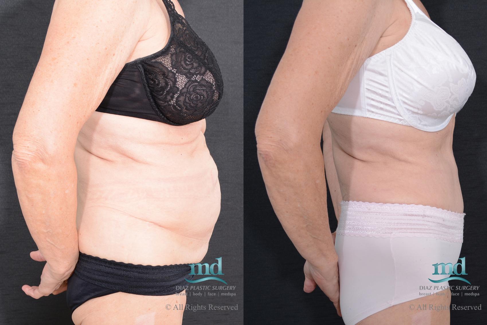 Before & After Tummy Tuck Case 87 View #3 View in Melbourne, FL