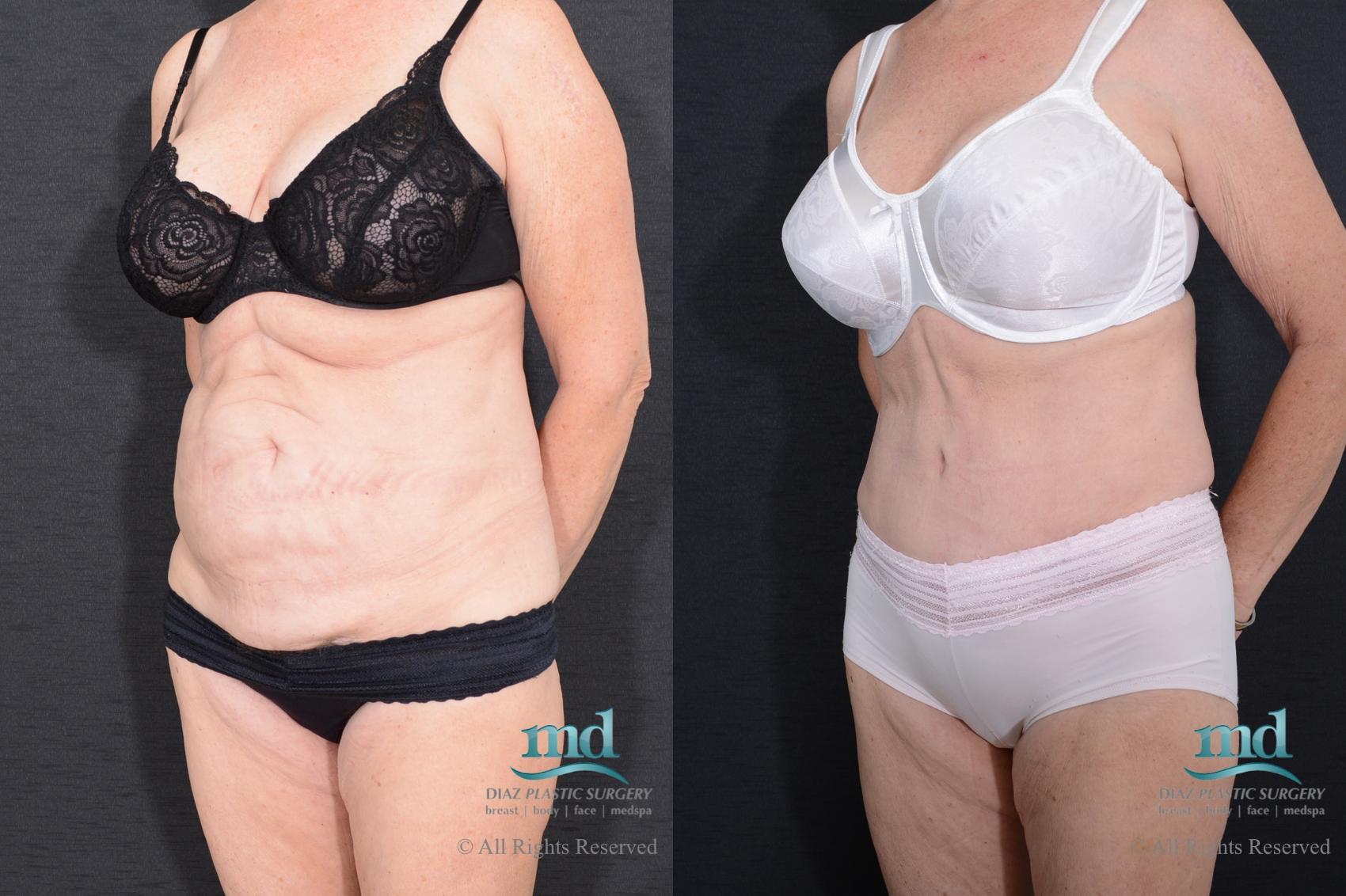 Before & After Tummy Tuck Case 87 View #4 View in Melbourne, FL