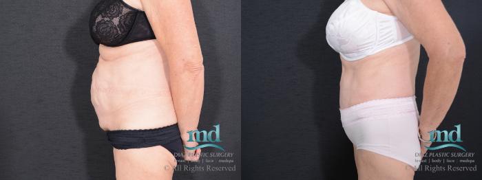 Before & After Tummy Tuck Case 87 View #5 View in Melbourne, FL