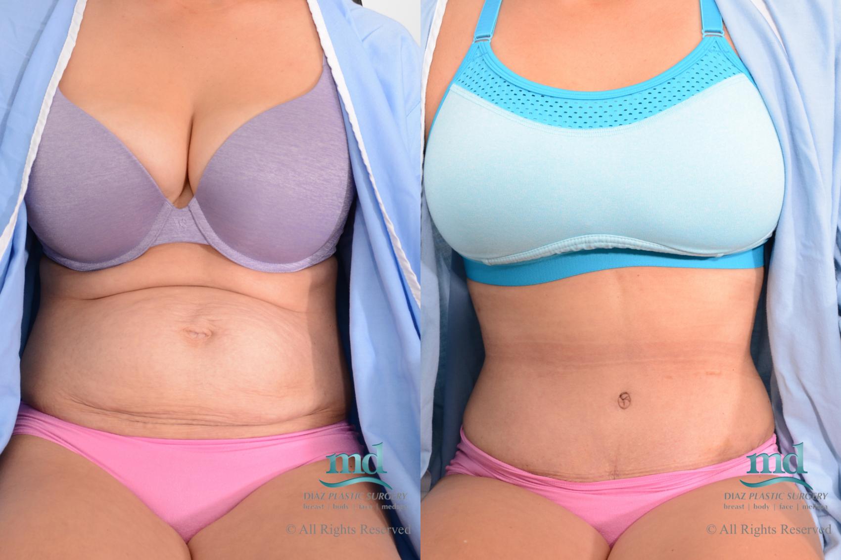 Before & After Tummy Tuck Case 89 View #1 View in Melbourne, FL
