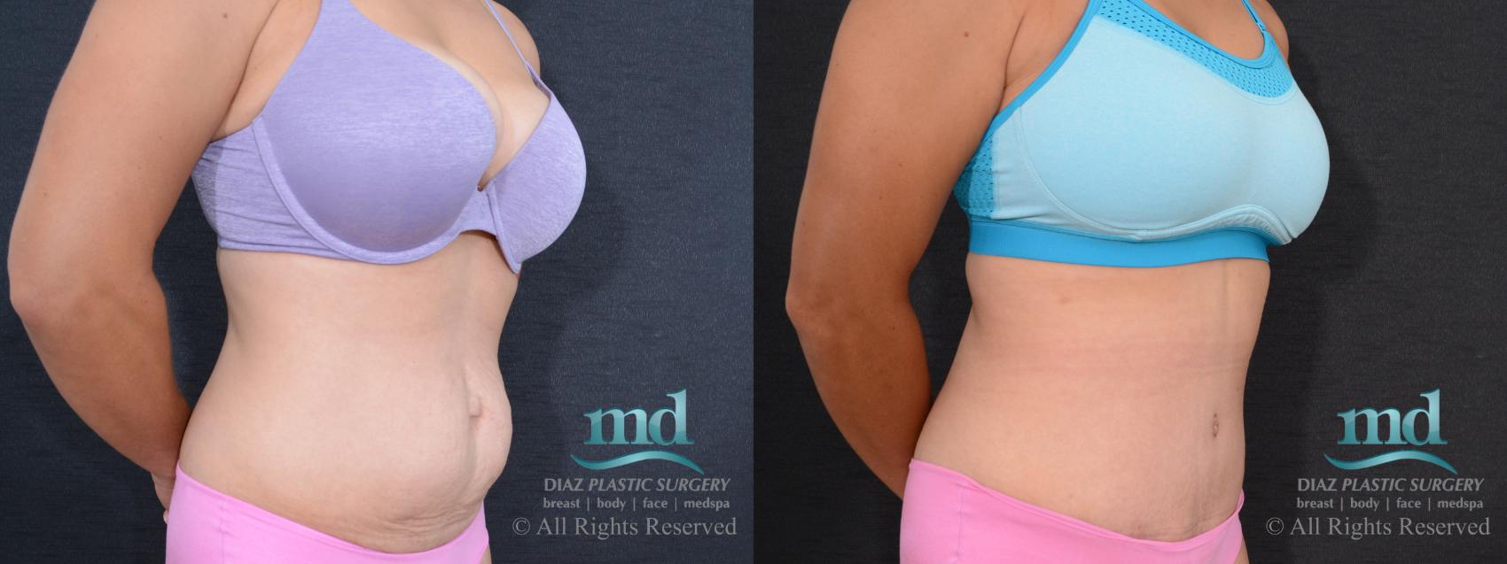 Before & After Tummy Tuck Case 89 View #3 View in Melbourne, FL