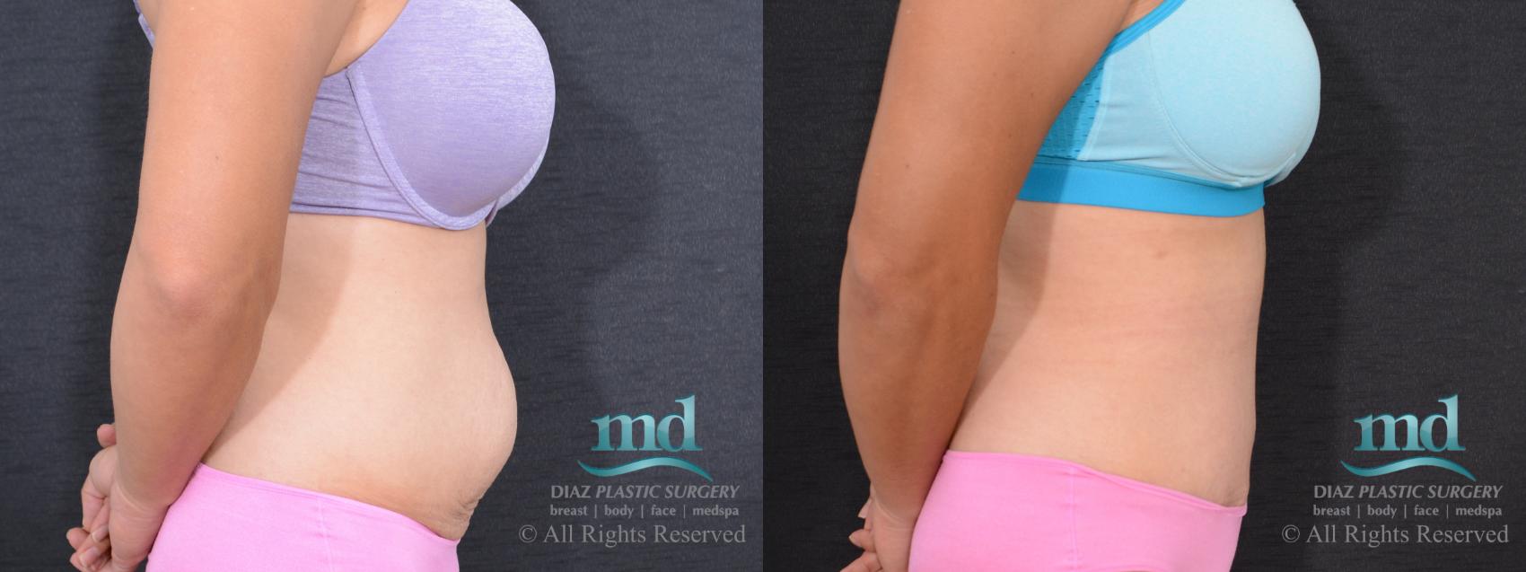 Before & After Tummy Tuck Case 89 View #4 View in Melbourne, FL