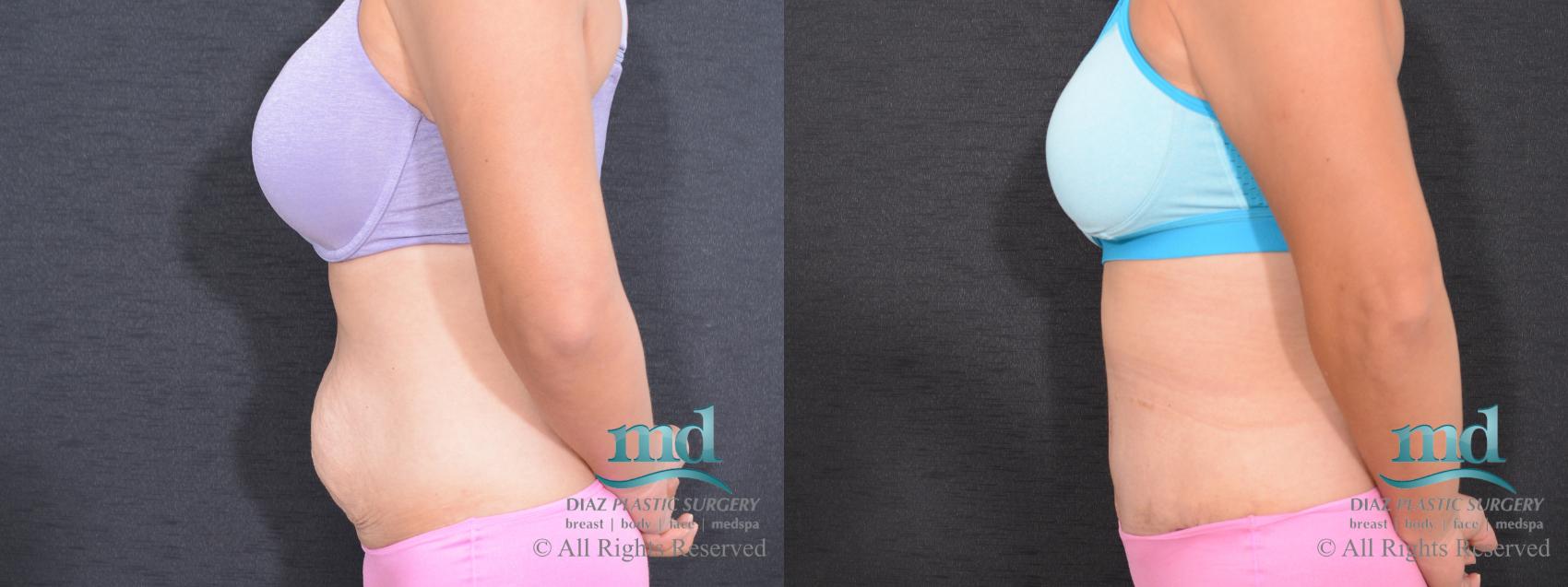 Before & After Tummy Tuck Case 89 View #6 View in Melbourne, FL