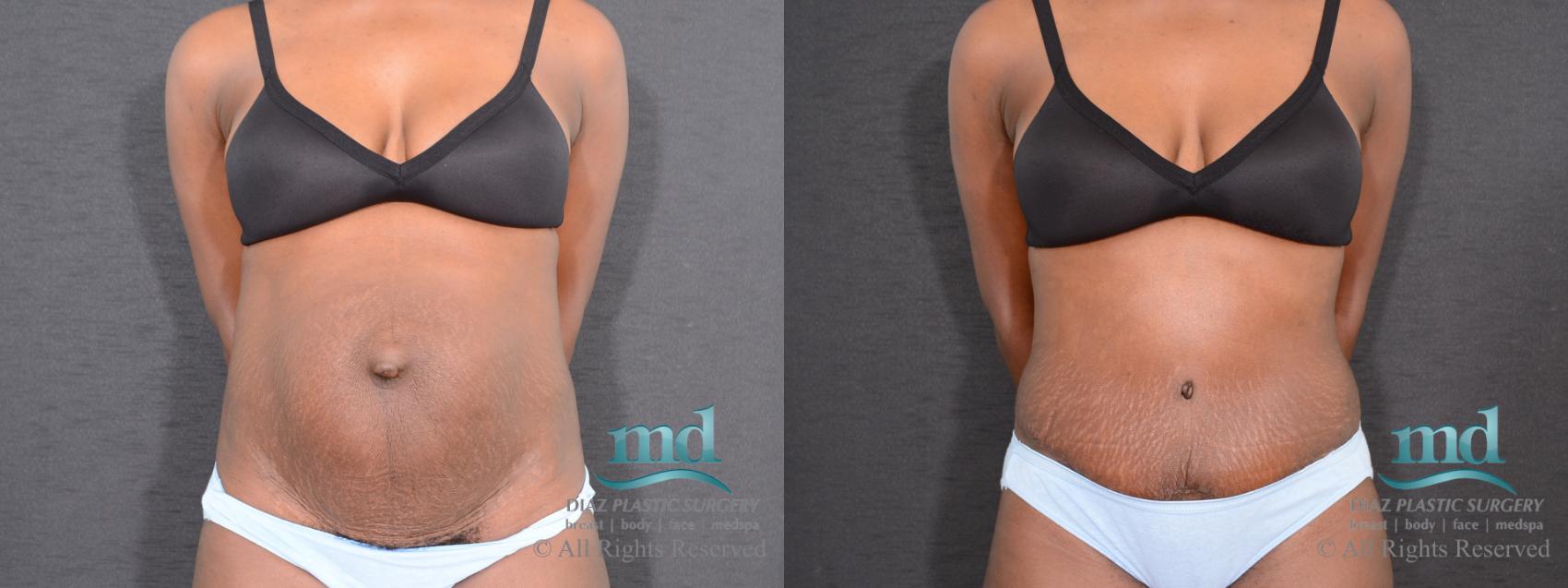 Before & After Tummy Tuck Case 9 View #1 View in Melbourne, FL