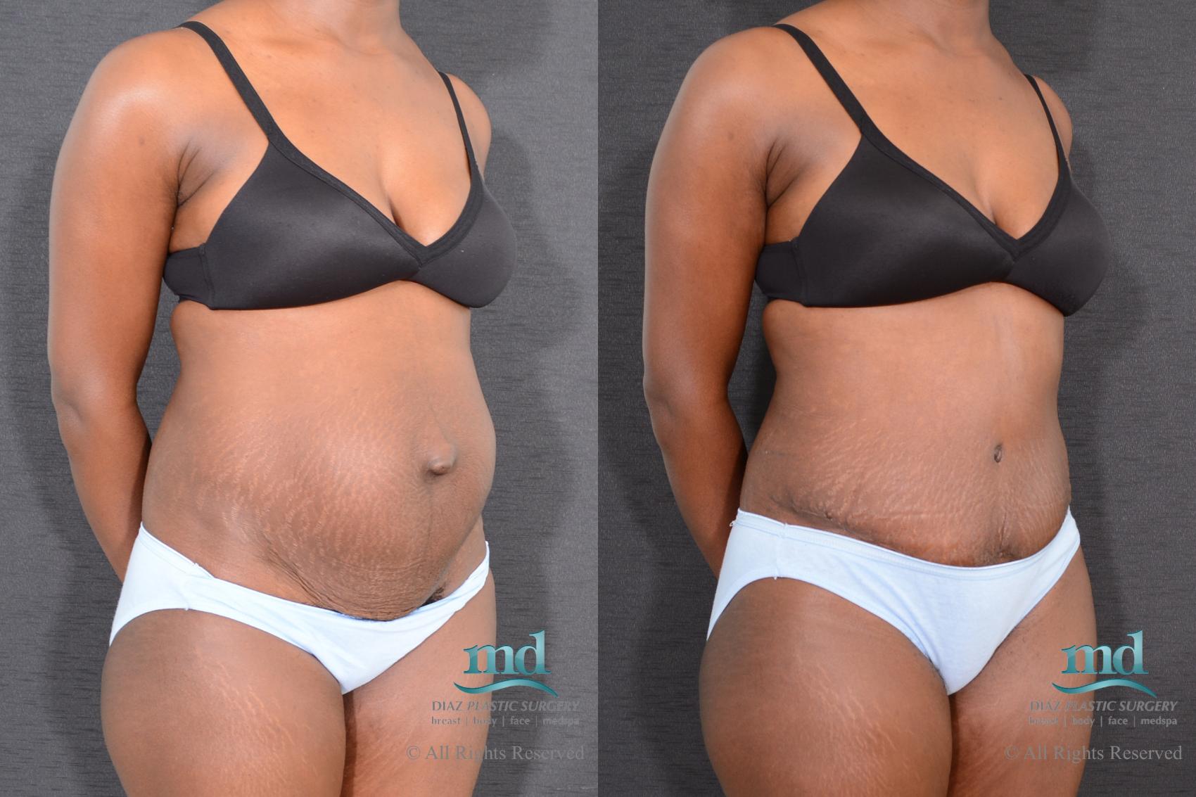 Before & After Tummy Tuck Case 9 View #2 View in Melbourne, FL