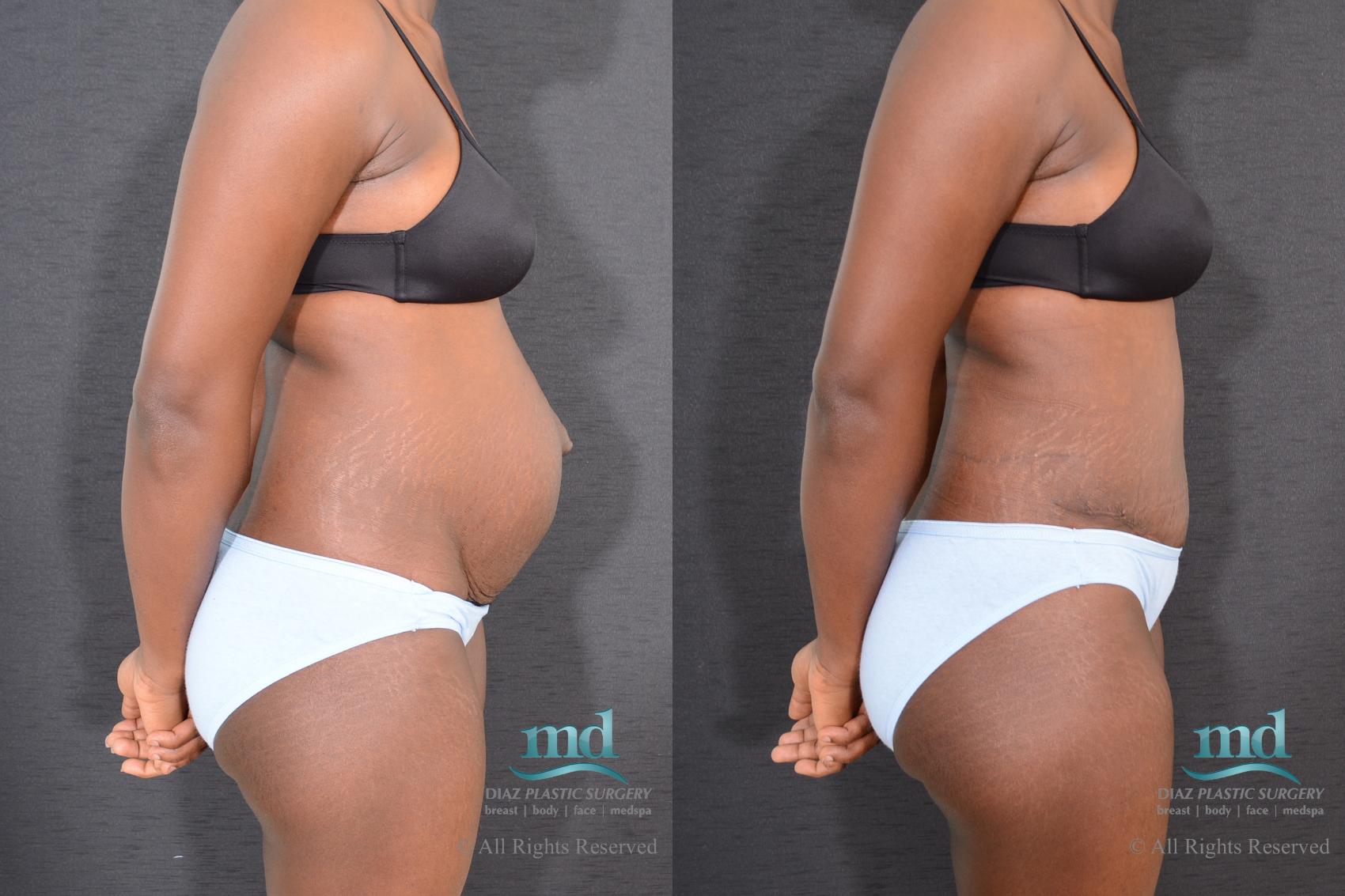 Before & After Tummy Tuck Case 9 View #3 View in Melbourne, FL