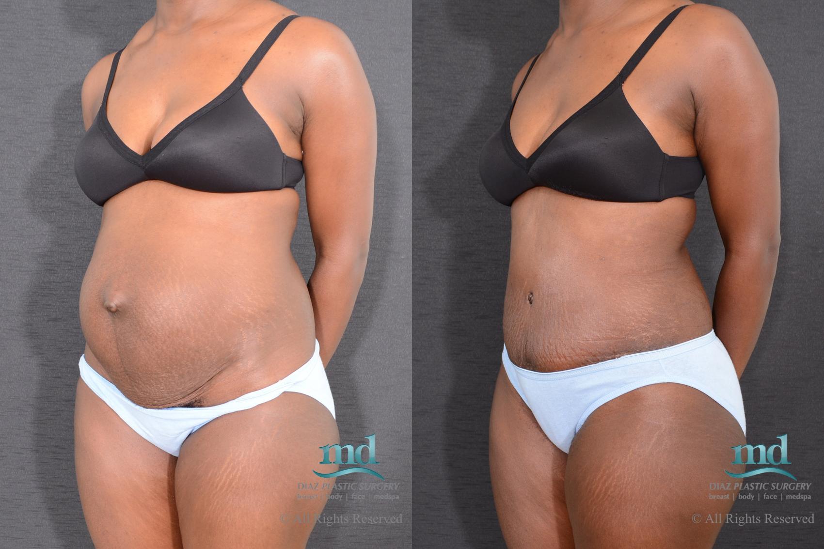 Before & After Tummy Tuck Case 9 View #4 View in Melbourne, FL