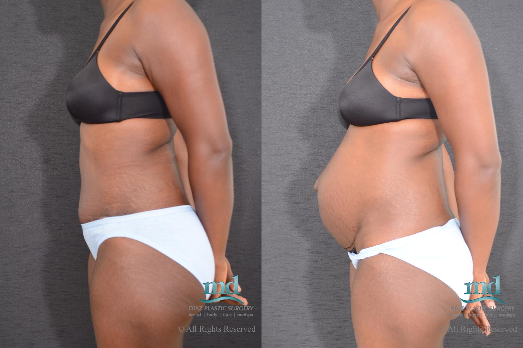 Before & After Tummy Tuck Case 9 View #5 View in Melbourne, FL