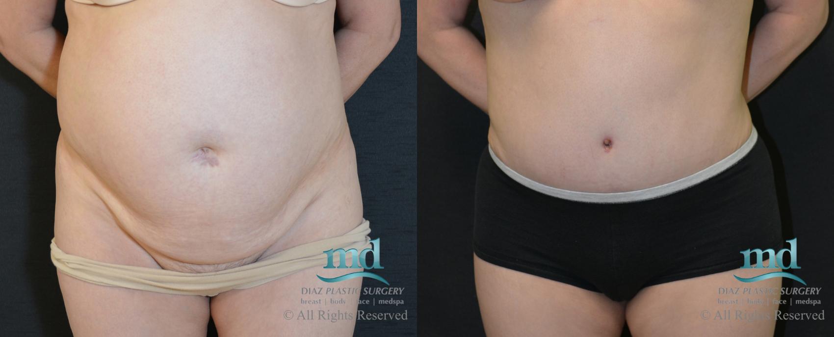 Before & After Tummy Tuck Case 90 View #1 View in Melbourne, FL