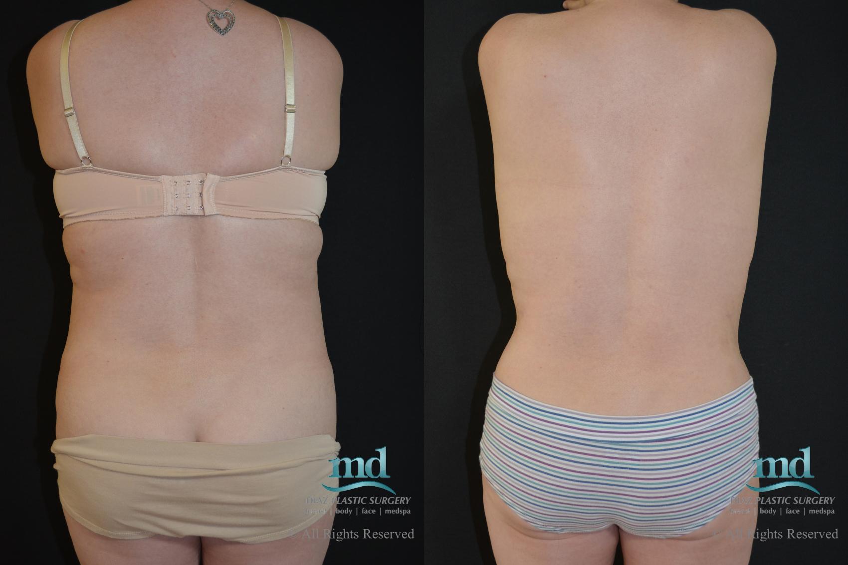 Before & After Tummy Tuck Case 90 View #2 View in Melbourne, FL