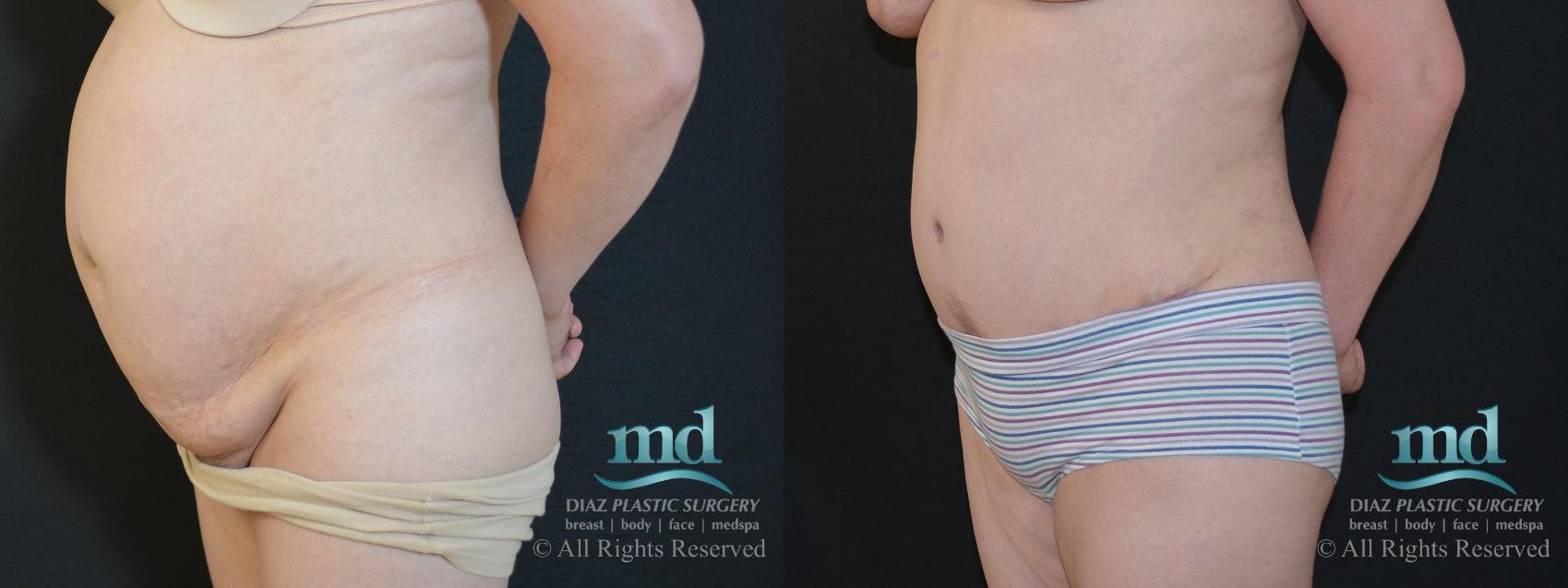 Before & After Tummy Tuck Case 90 View #4 View in Melbourne, FL
