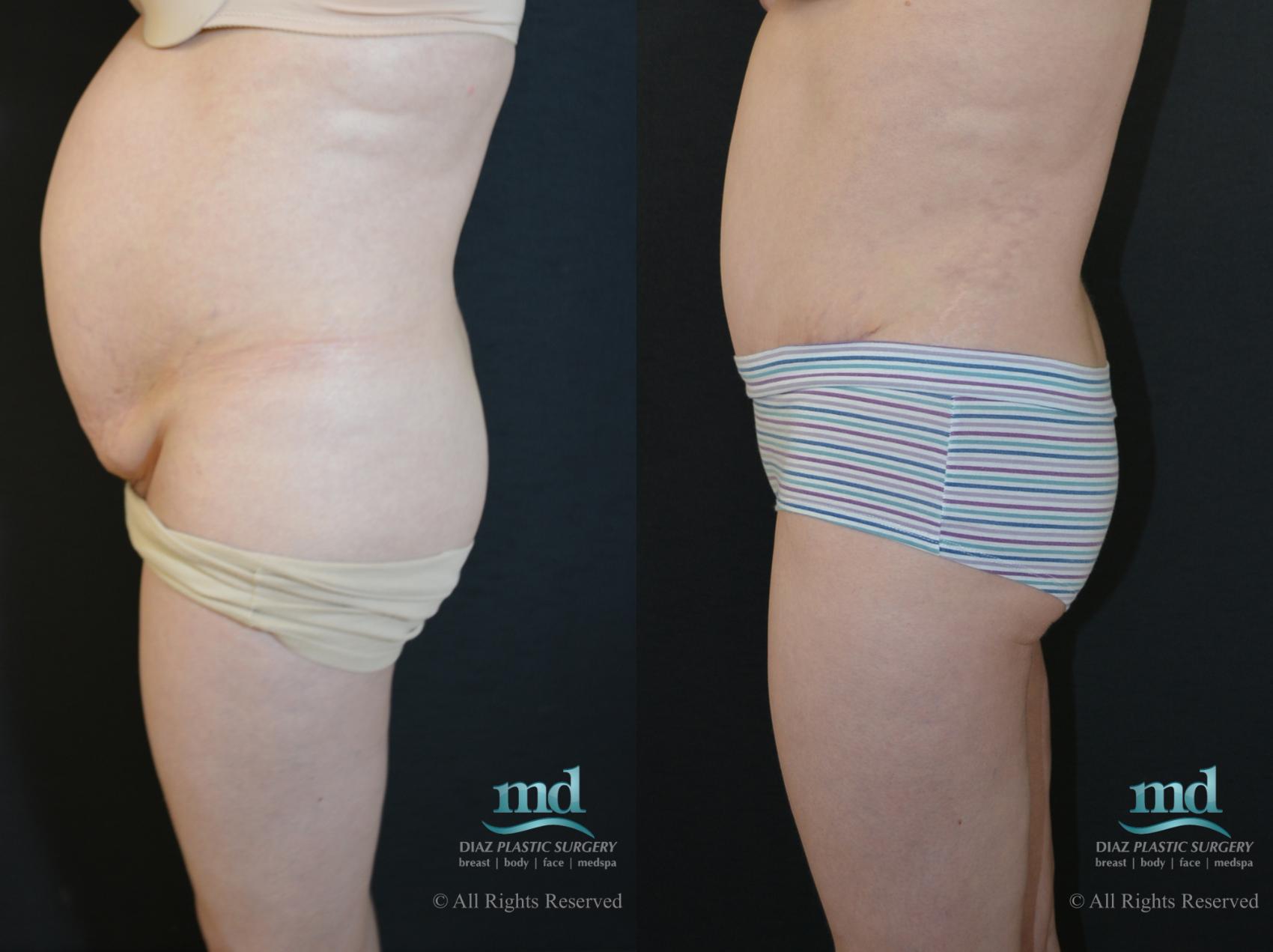 Before & After Tummy Tuck Case 90 View #5 View in Melbourne, FL