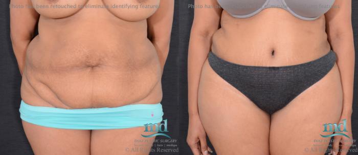 Before & After Tummy Tuck Case 91 View #1 View in Melbourne, FL