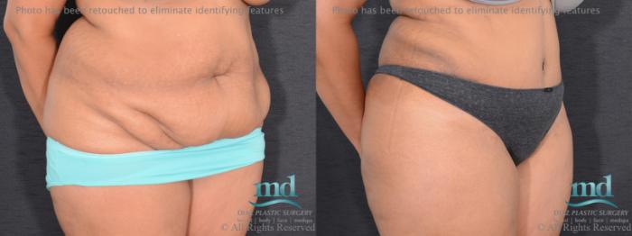 Before & After Tummy Tuck Case 91 View #2 View in Melbourne, FL