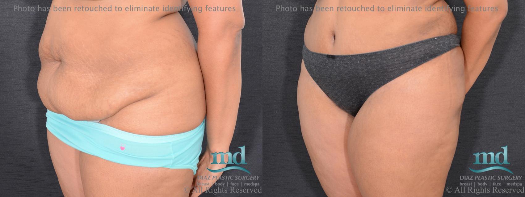 Before & After Tummy Tuck Case 91 View #3 View in Melbourne, FL