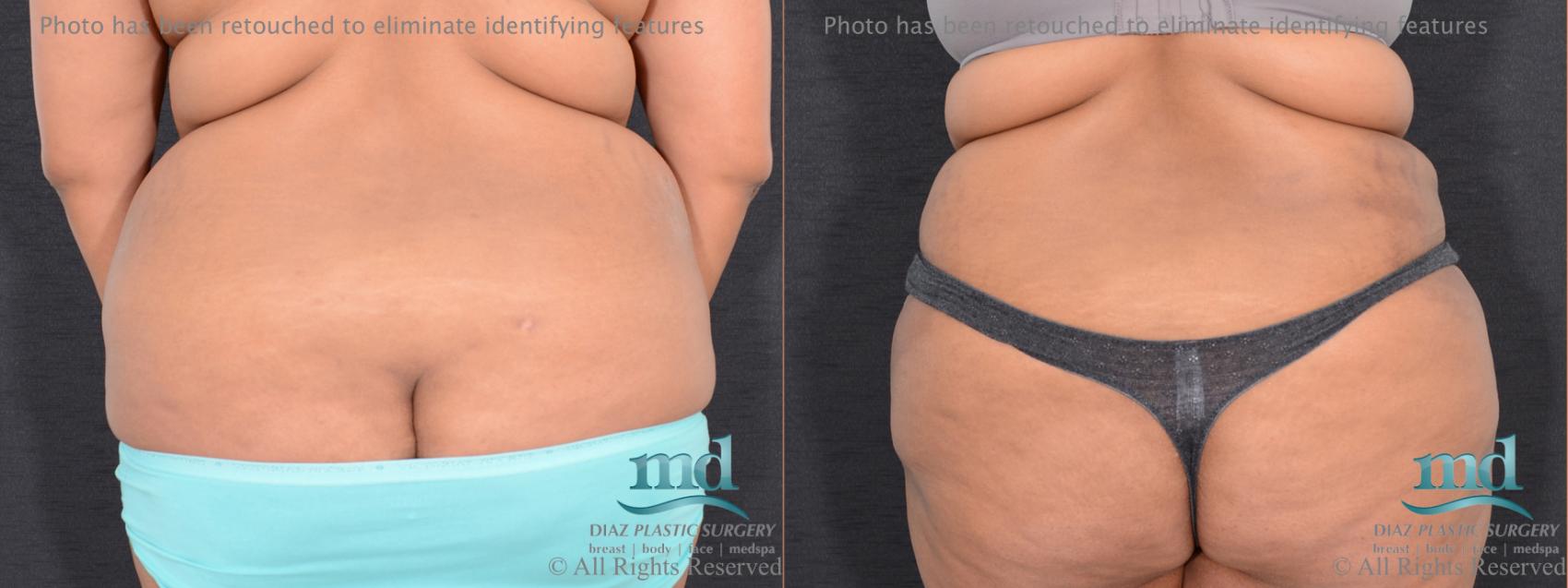 Before & After Tummy Tuck Case 91 View #4 View in Melbourne, FL