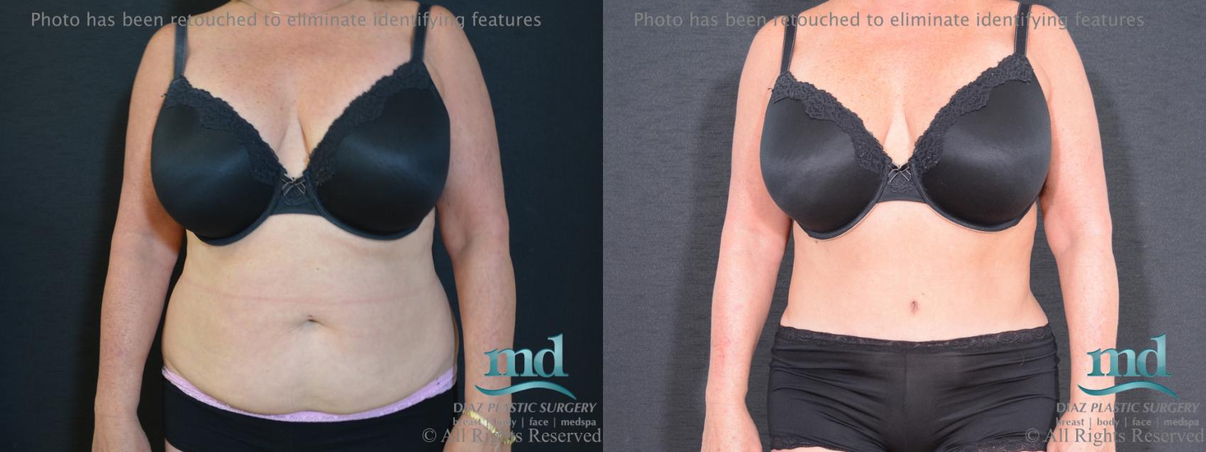 Before & After Tummy Tuck Case 92 View #1 View in Melbourne, FL