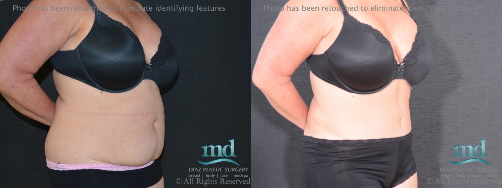 Before & After Tummy Tuck Case 92 View #2 View in Melbourne, FL