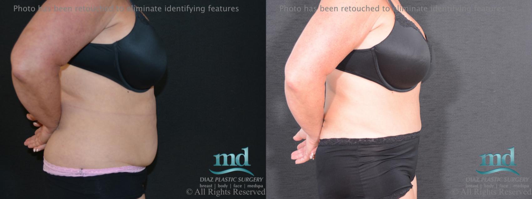 Before & After Tummy Tuck Case 92 View #3 View in Melbourne, FL