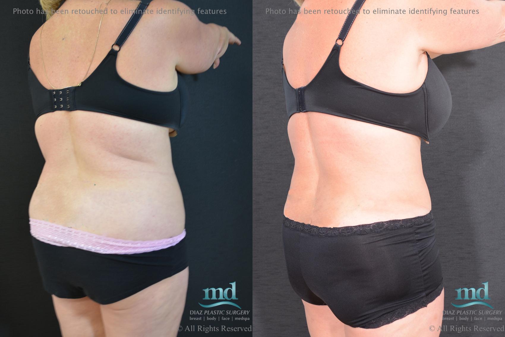 Before & After Tummy Tuck Case 92 View #4 View in Melbourne, FL