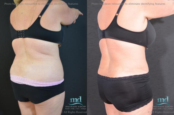 Before & After Tummy Tuck Case 92 View #4 View in Melbourne, FL