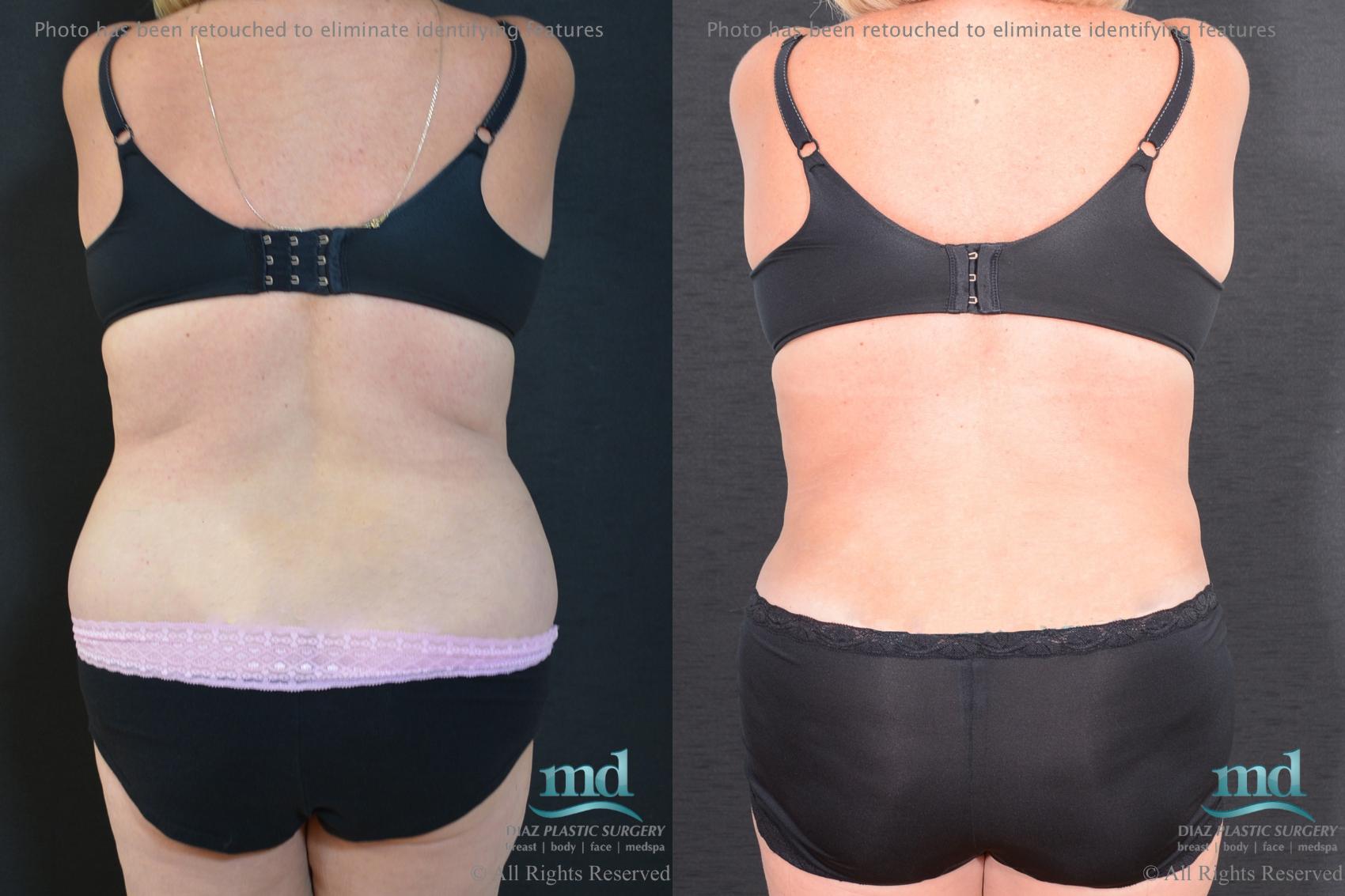 Before & After Tummy Tuck Case 92 View #5 View in Melbourne, FL