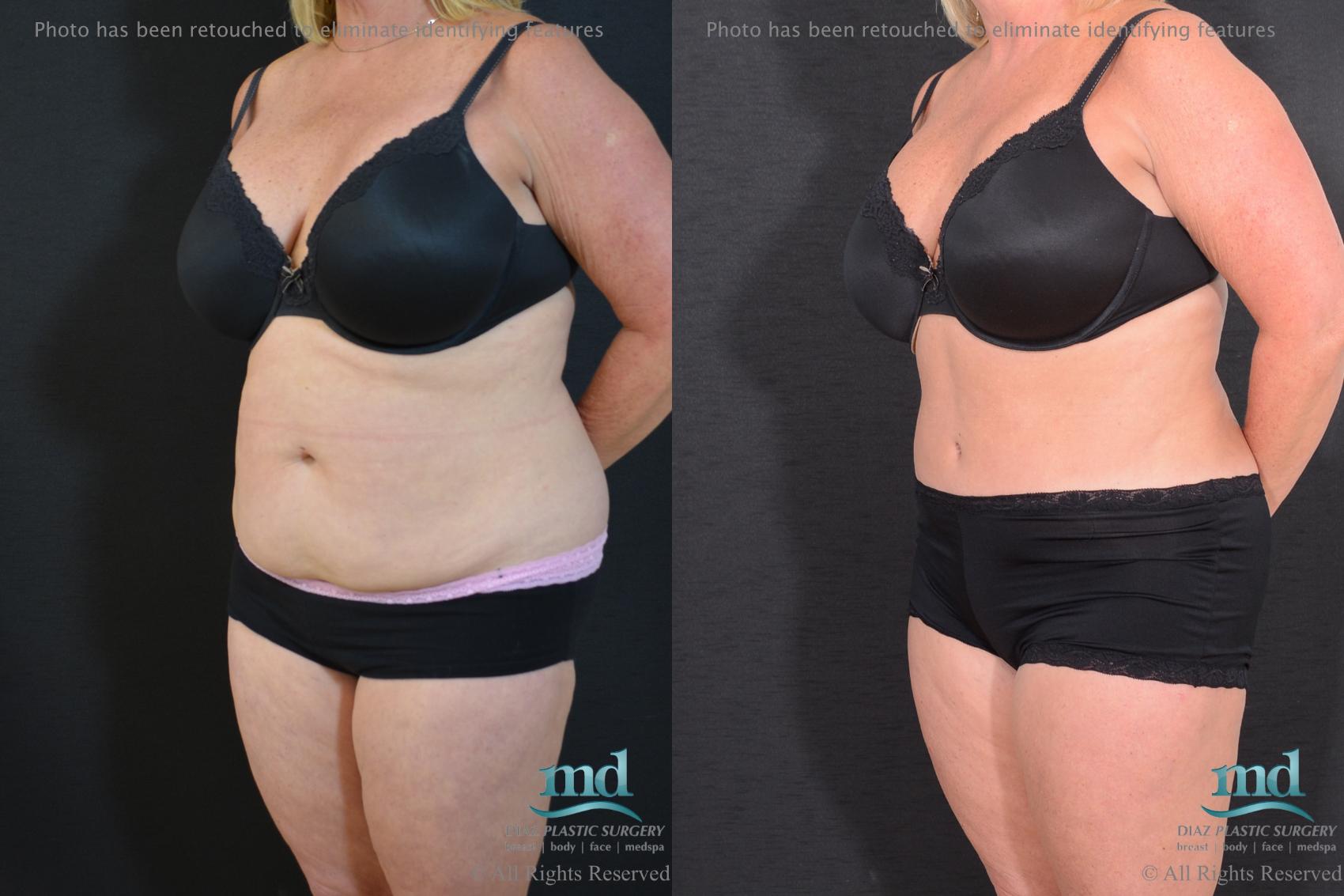 Before & After Tummy Tuck Case 92 View #6 View in Melbourne, FL