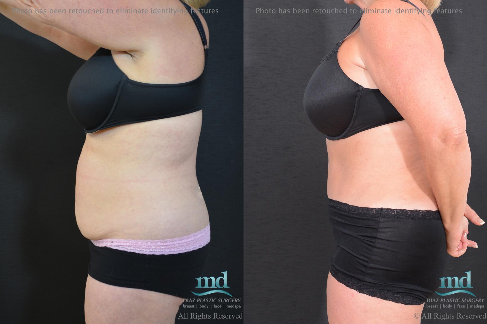 Before & After Tummy Tuck Case 92 View #7 View in Melbourne, FL