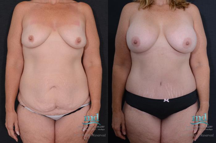 Before & After Tummy Tuck Case 95 View #1 View in Melbourne, FL