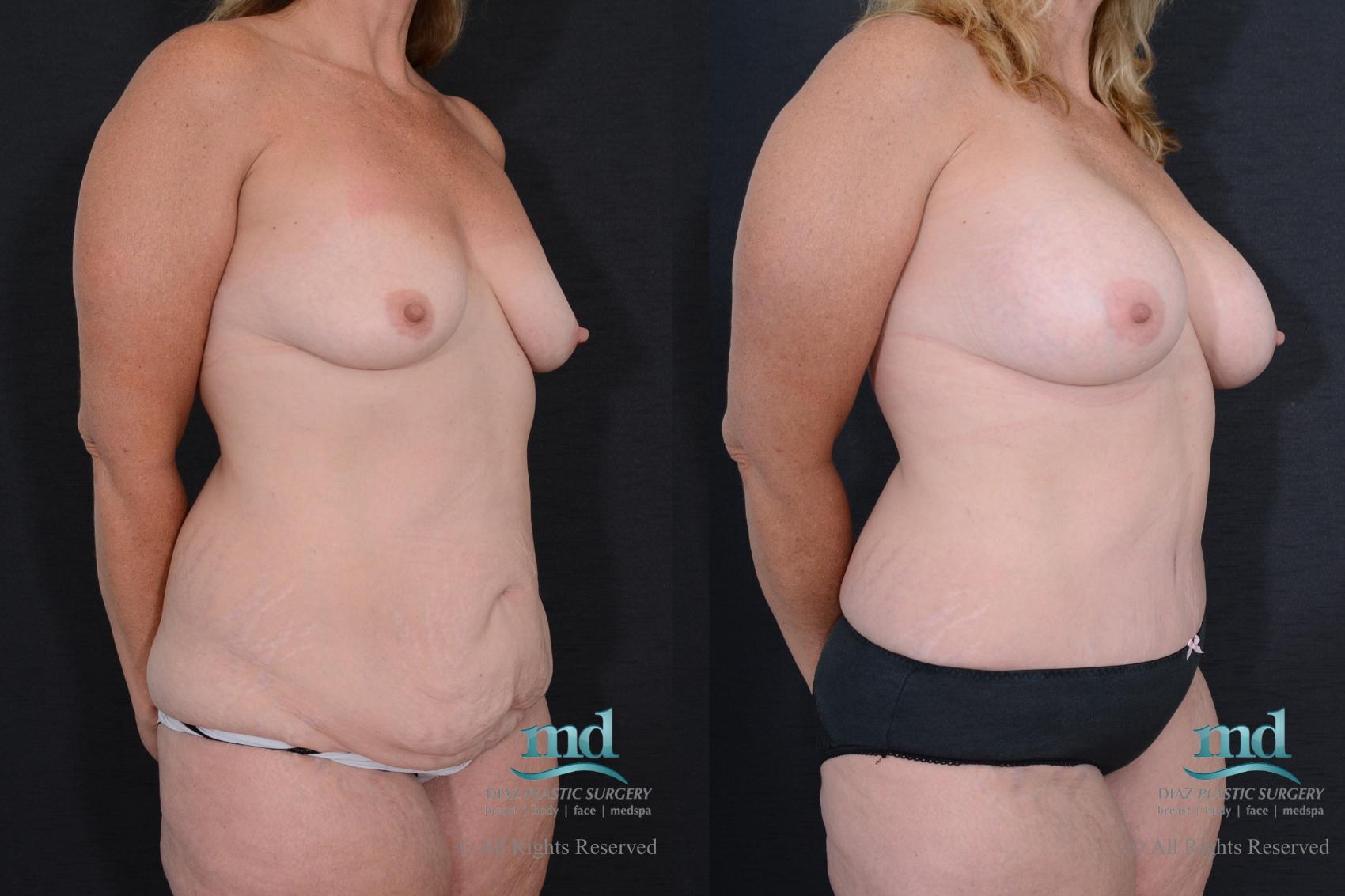 Before & After Tummy Tuck Case 95 View #2 View in Melbourne, FL