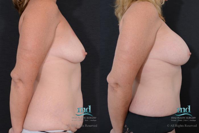 Before & After Tummy Tuck Case 95 View #3 View in Melbourne, FL
