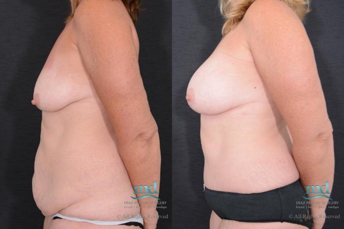 Before & After Tummy Tuck Case 95 View #5 View in Melbourne, FL